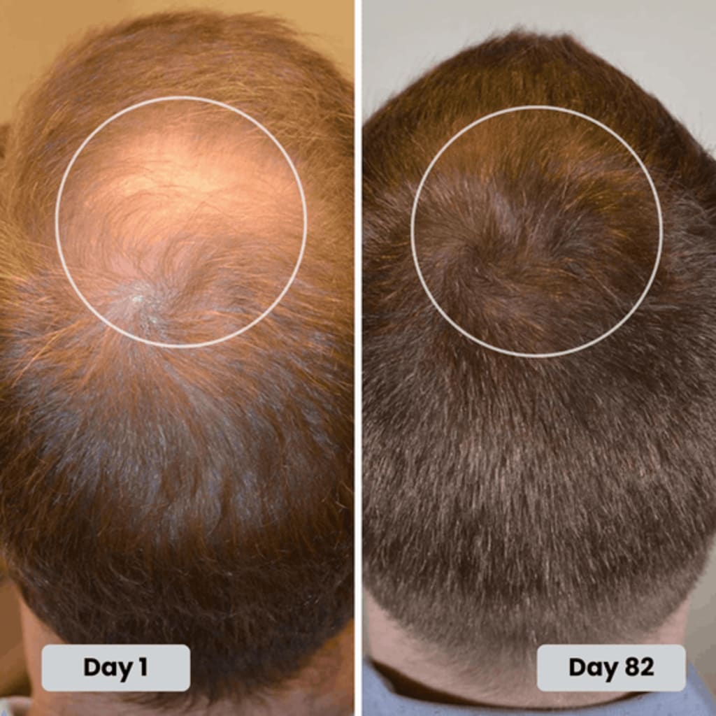 Hair progress over several months